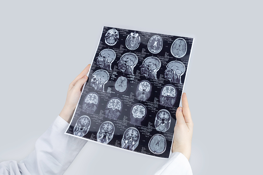 What Are the Different Types of TBIs?